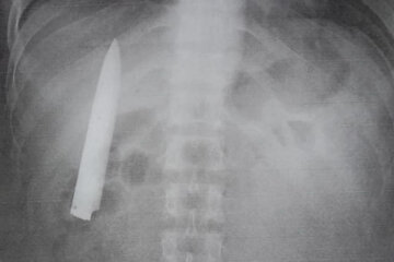 врачи забыли нож в груди пациента