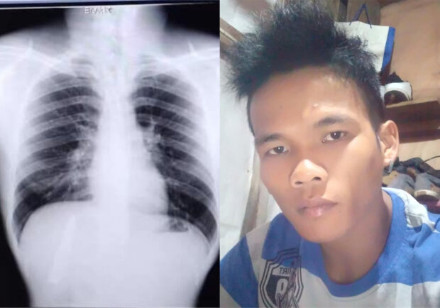 врачи забыли нож в груди пациента