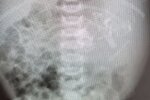 дівчинка народилася з близнюком в шлунку