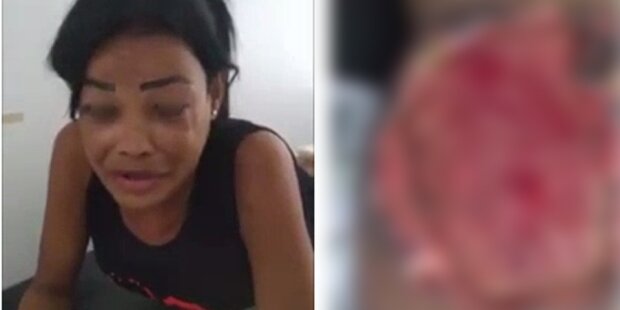 Женщине вырезали попу после инъекций красоты