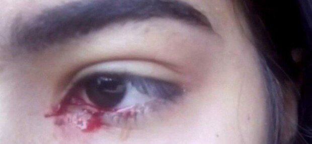 15-річна дівчинка тиждень плаче кров'ю