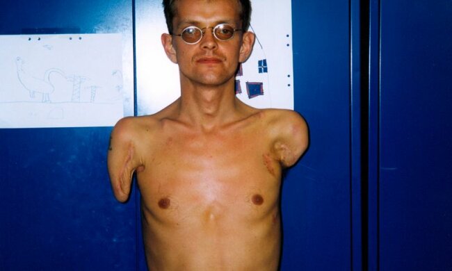 чоловікові зробили трансплантацію рук