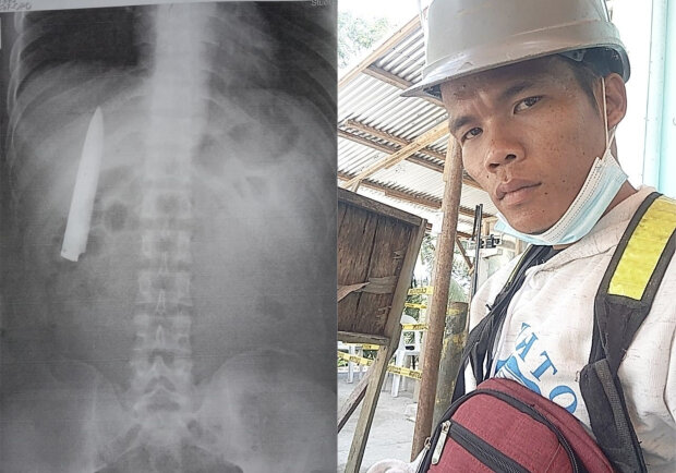 врачи забыли нож в груди пациента