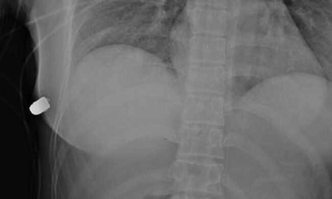 Бюст жінки зупинив кулю, яка летіла прямо у серце