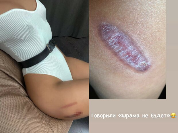 модель отримала опіки в салоні краси