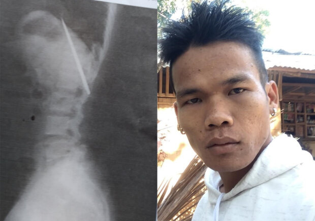 врачи забыли нож в груди пациента