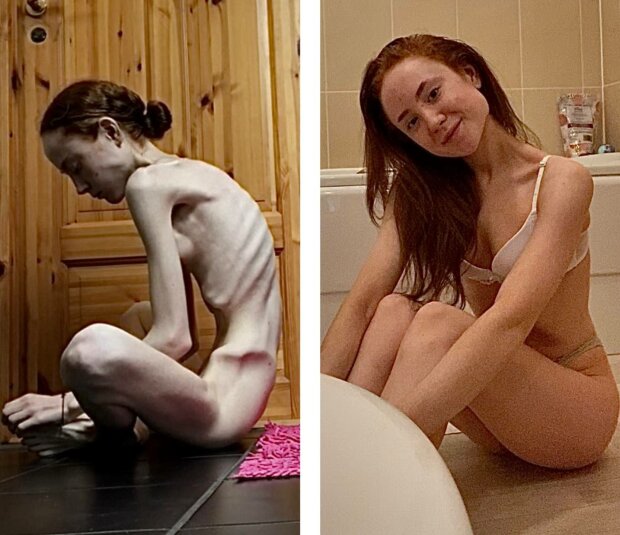 Издевательства в школе довели девочку до анорексии