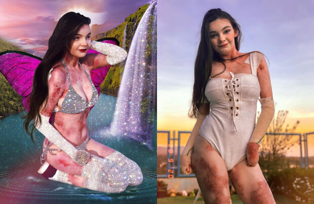 модель с волдырями и язвами