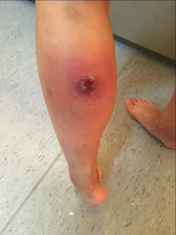 укус павука-ложної вдови