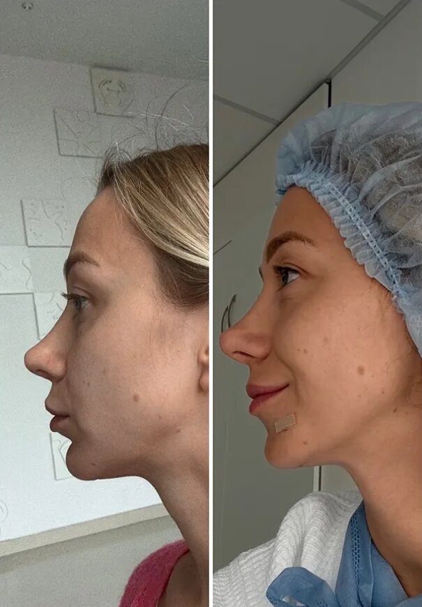 Жена Виктора Павлика Катя Репяхова сделала очередную пластическую операцию