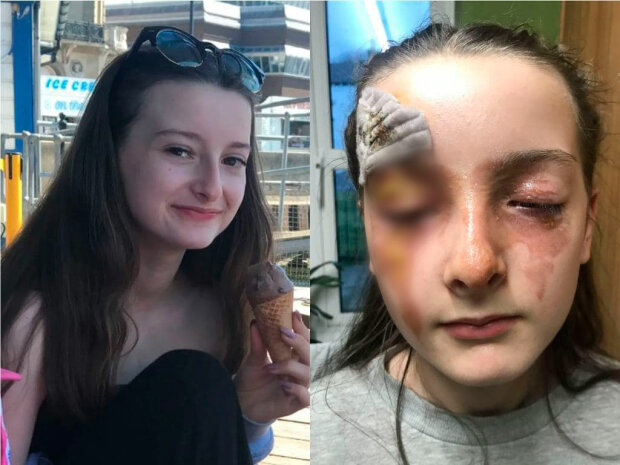 дівчинка отримала сильні опіки, спробувавши рецепт з інтернету