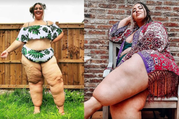 ноги девушки раздулись до невероятных размеров