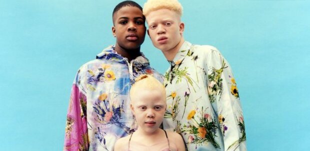 Фото дітей-альбіносів