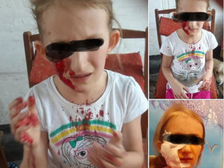 Пес вчепився дівчині в обличчя просто на дитячому майданчику