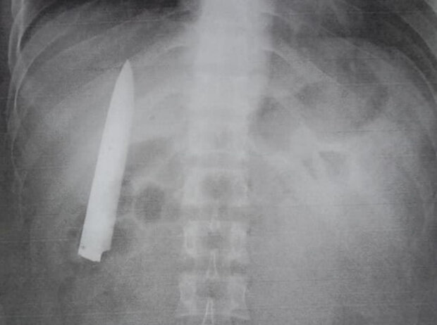 врачи забыли нож в груди пациента