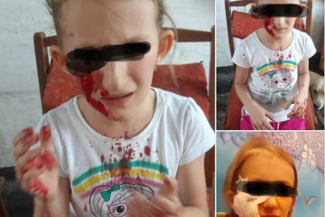 Пес вцепился девушке в лицо прямо на детской площадке: мать умоляет о помощи