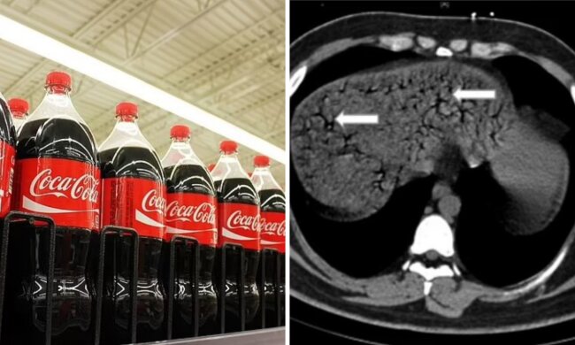 Чоловік залпом випив півтора літра Coca Cola і помер