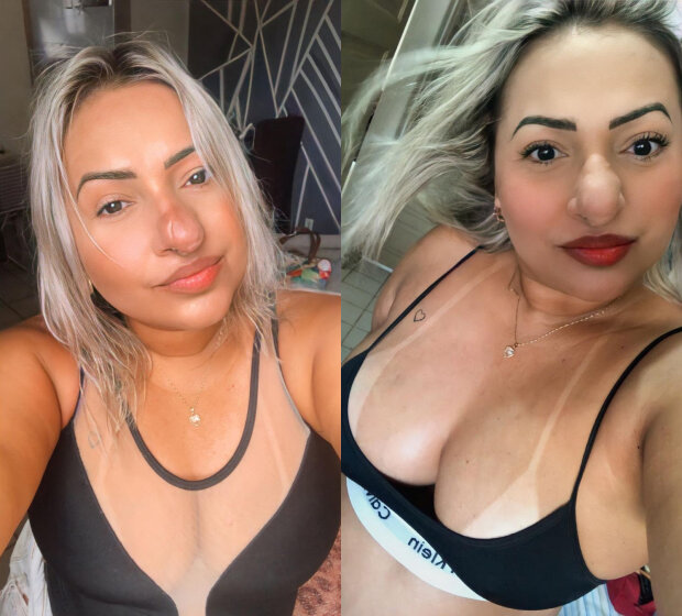 Девушке с редким заболеванием сделали пересадку кожи на нос