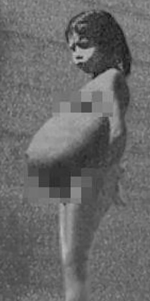 девочка родила в пять лет