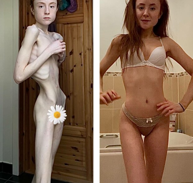 Издевательства в школе довели девочку до анорексии