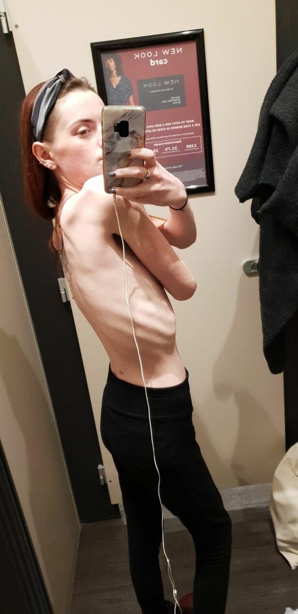 27-летняя женщина рвет 30 раз в день из-за редкой болезни