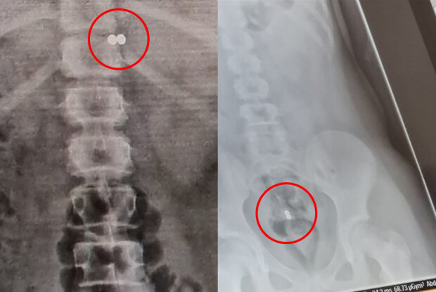 девочка проглотила магниты ради славы в TikTok