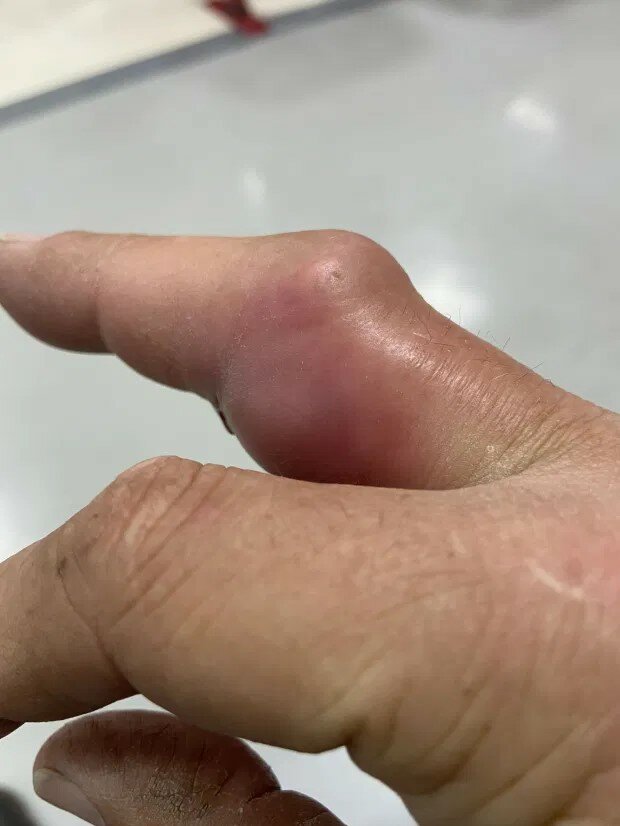 укус павука-ложної вдови