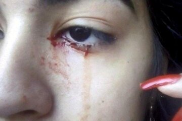 15-річна дівчинка тиждень плаче кров'ю