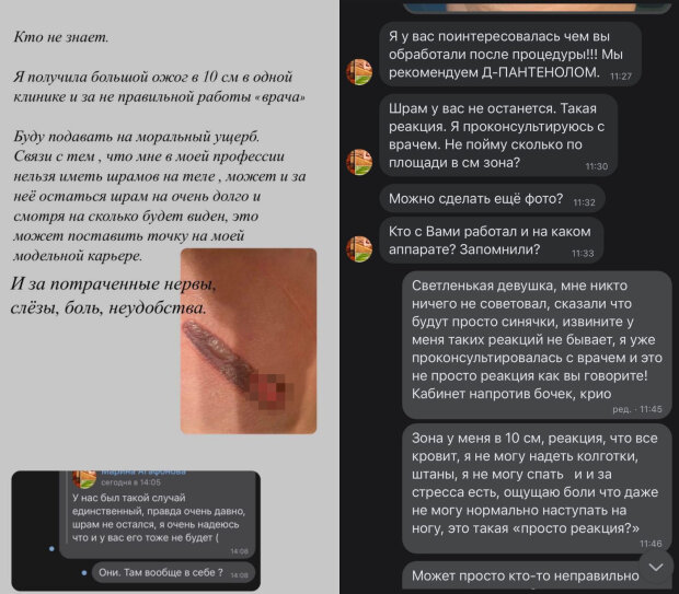 модель отримала опіки в салоні краси