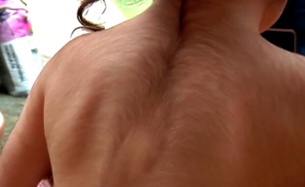 Синдром оборотня, фото: nypost.com