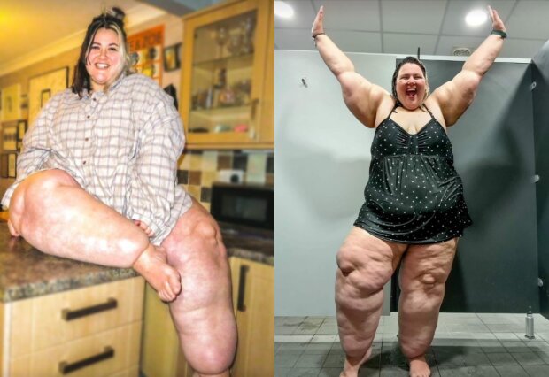 ноги девушки раздулись до невероятных размеров