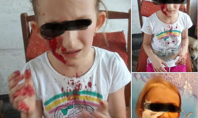 Пес вчепився дівчині в обличчя просто на дитячому майданчику