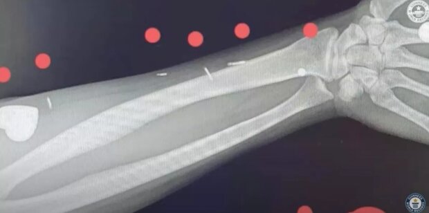 Имплатны в теле Анастасии