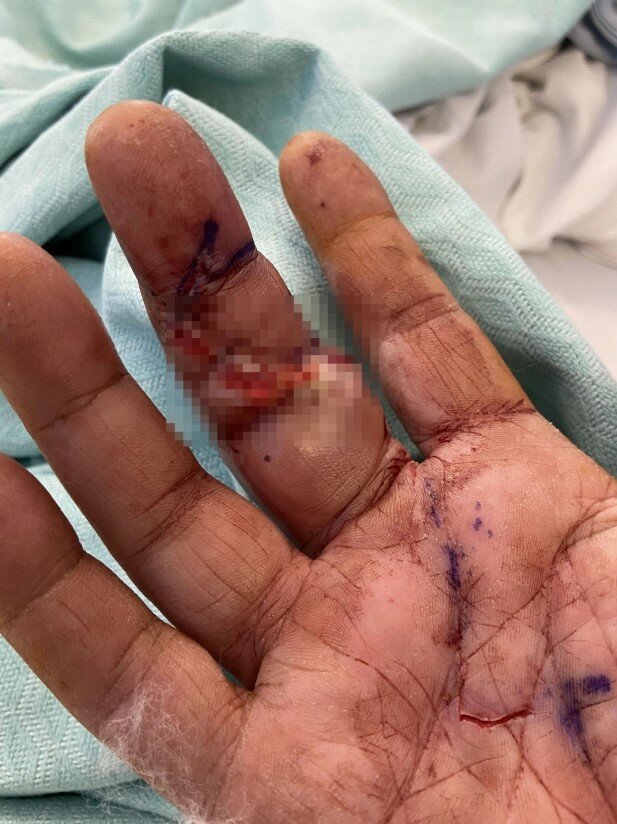 укус павука-ложної вдови