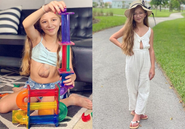 Дівчинка народилася з серцем зовні