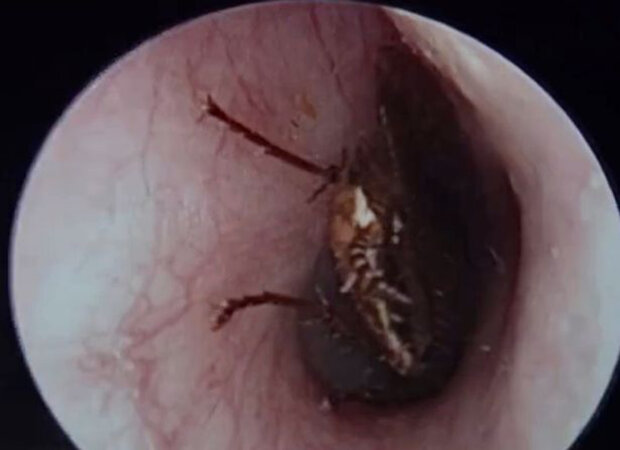 Величезний тарган заповз дівчинці у вухо