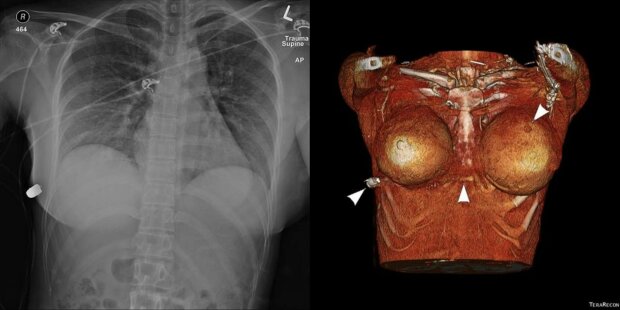 Бюст жінки зупинив кулю, яка летіла прямо у серце