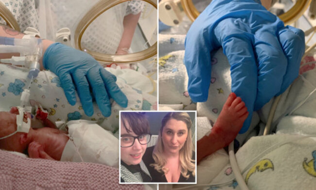 Лікарі врятували недоношеного новонародженого запхавши його в кульок для бутербродів