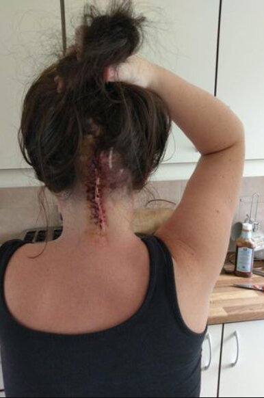 Дівчина після опарации