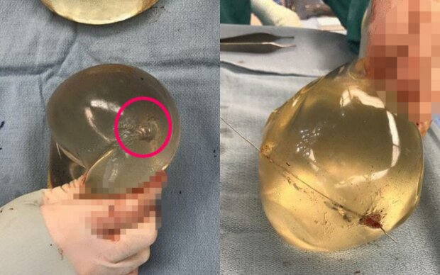 Бюст жінки зупинив кулю, яка летіла прямо у серце