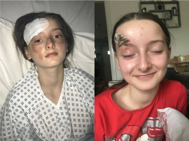 дівчинка отримала сильні опіки, спробувавши рецепт з інтернету